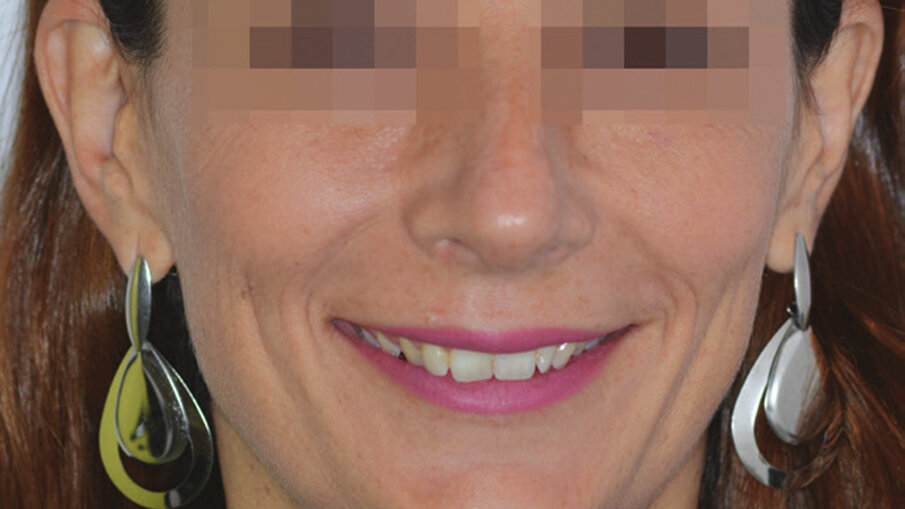 Figg. 10a, 10b_Foto extraorali ed intraorali di inizio trattamento. Il sorriso iniziale della paziente non permetteva una eccessiva intrusione degli incisivi superiori ma, nonostante questo, risulta migliorato il display dentale e l’ampiezza del sorriso.