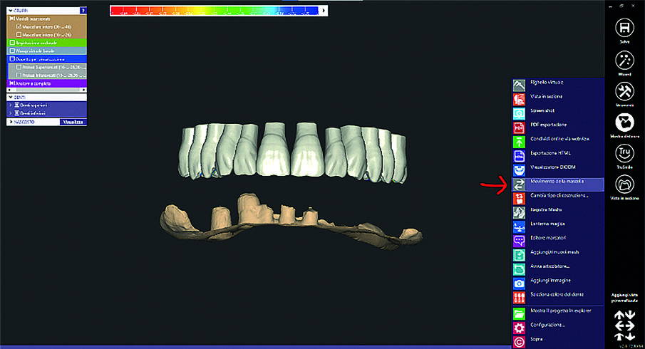 Fig. 9: Diagnostic tooth arrangement in the maxilla.