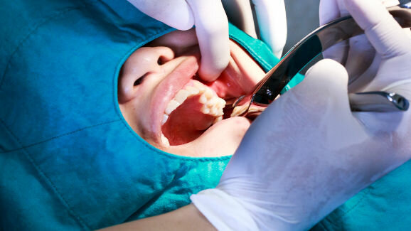 Avoiding common problems in tooth extractions