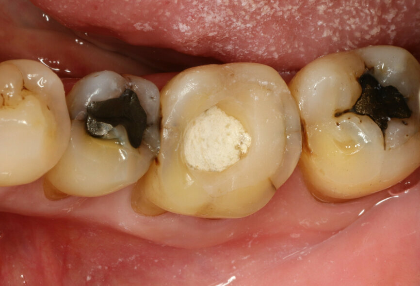 Fig. 3: Tooth #36 initial situation.