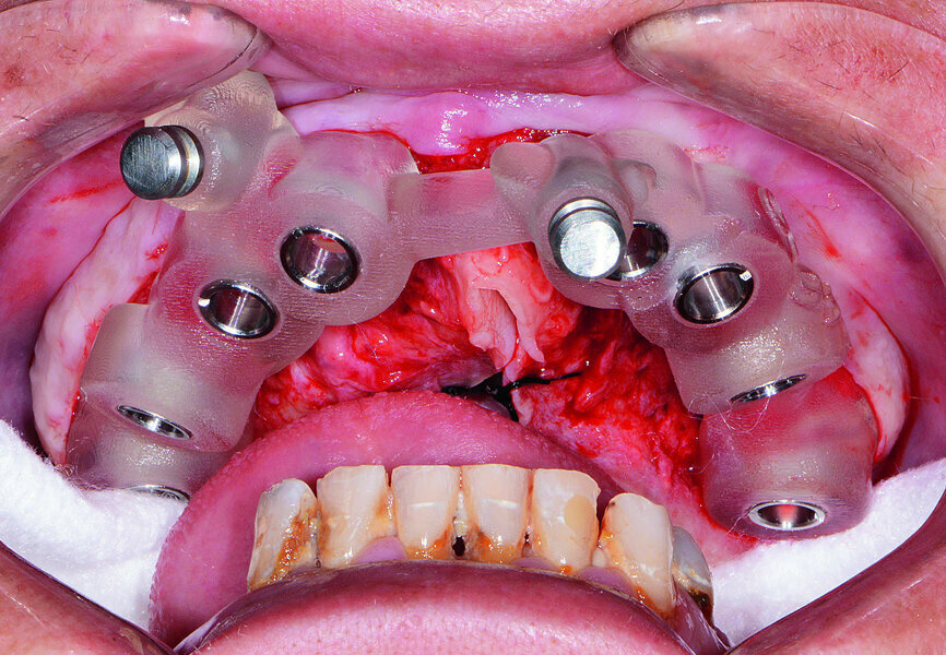 Fig. 9: Placement of maxillary surgical guide.