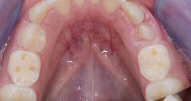 Erozije zuba – kako nastaju i kako ih kontrolisati?