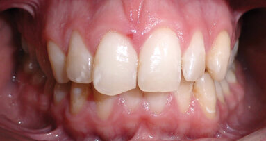 Il trattamento ClearCorrect® per l’accavallamento e la costrizione delle arcate dentali