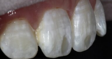 Leczenie białych plam na powierzchniach wargowych zębów – opis przypadku