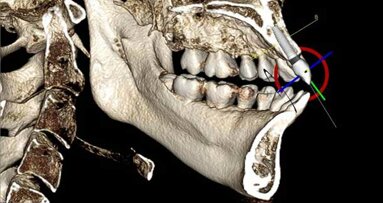 3D imaging: Increasing implant accuracy