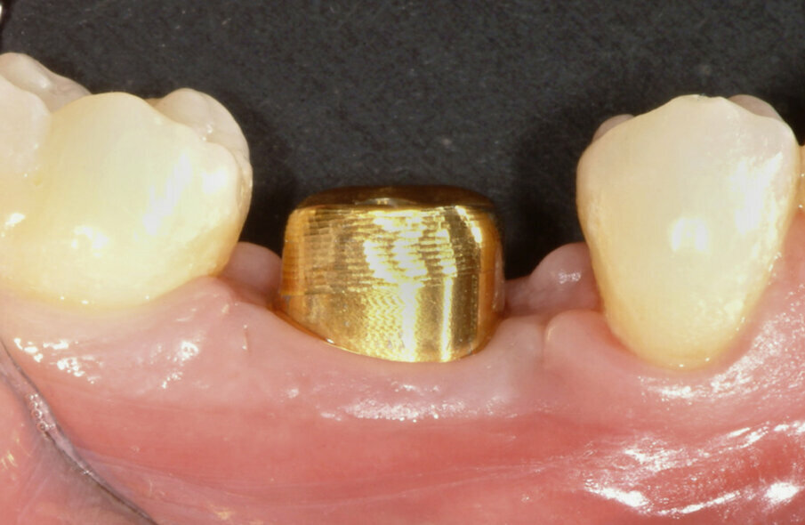 Fig. 16: The Atlantis abutment in gold-shaded titanium was
torqued to the implant manufacturer’s recommendation of 25 Ncm. The screw head was covered, and the crown was later cemented to the abutment.