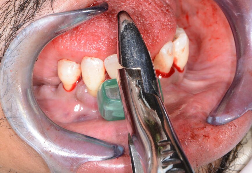 Fig. 11: Removing mandibular teeth.