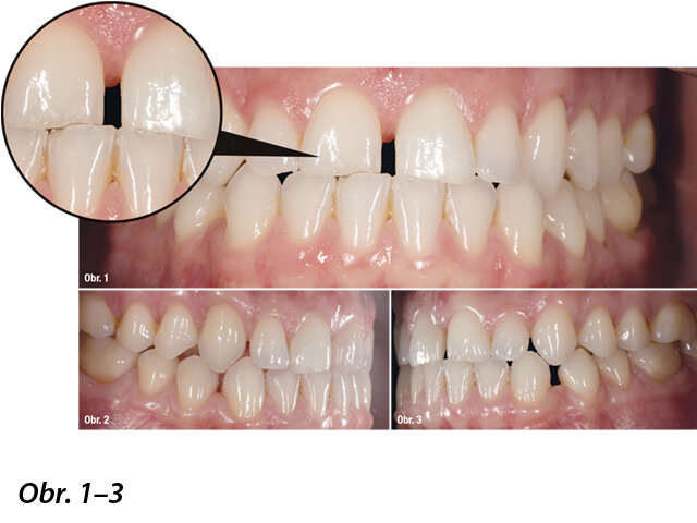 Obr. 1: Funkční porucha skusu a tím podmíněná ztráta (abraze) skloviny na incizálních hranách. Obr. 2: Další mezery u zubů 12 a 43 distálně. Obr. 3: Další mezery u zubů 33 a 22 distálně.