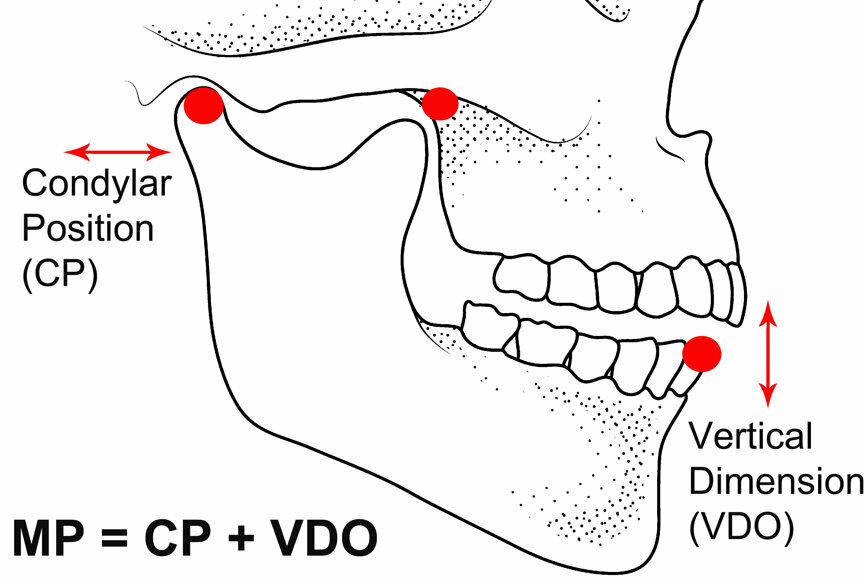 Fig. 4: Mandibular position defined as condylar position and vertical dimension of occlusion.