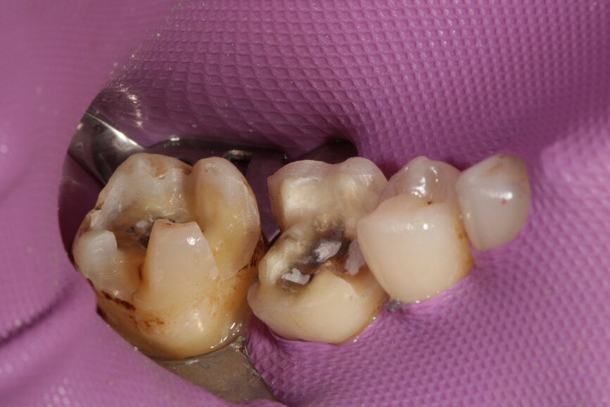 Fig. 8: The teeth are conditioned for adhesive bonding of the glass-ceramic restorations.