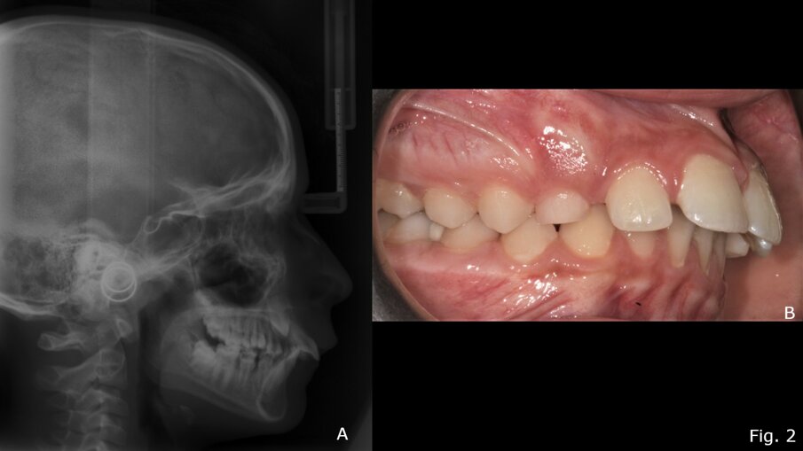 Fig. 2 - Teleradiografia latero-laterale pre-trattamento con Twin-Block (A); Foto occlusale destra pre-trattamento (B).