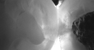 Near-infrared transillumination: Expert introduces X-ray-free caries diagnostic