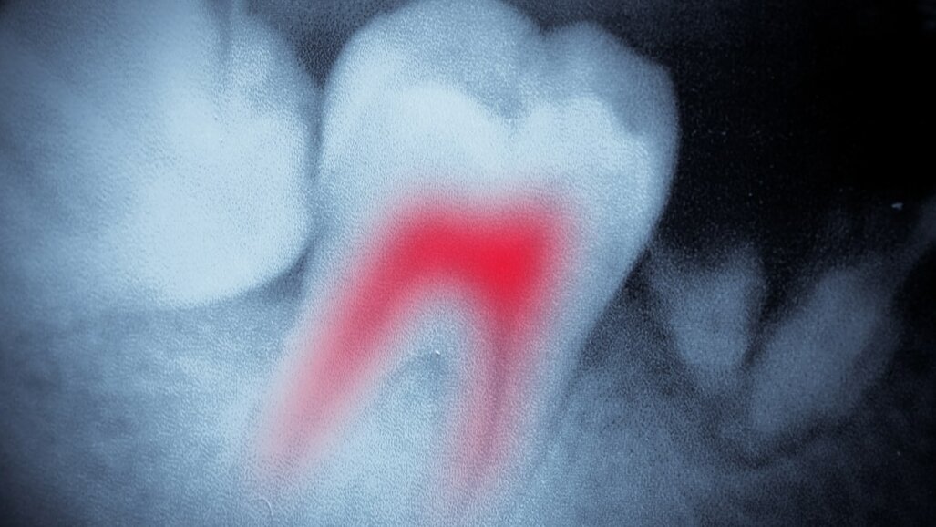 Lane keeping assistance systems in endodontics
