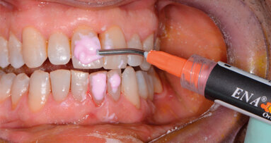 Il trattamento di sbiancamento autogestito dal paziente. Un rischio per la salute del cavo orale. Case report