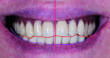 Implant-prosthetic restorations The challenge of creating an aesthetically pleasing smile in an edentulous patient