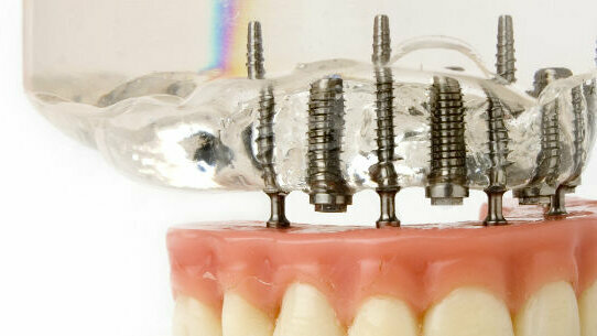 US scientists develop smart coating for dental implants