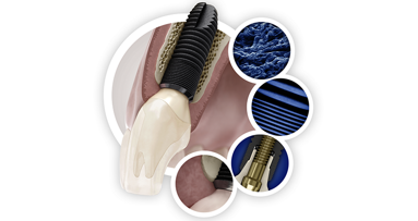 Simplicity without compromise with the Astra Tech Implant System EV from Dentsply Sirona Implants