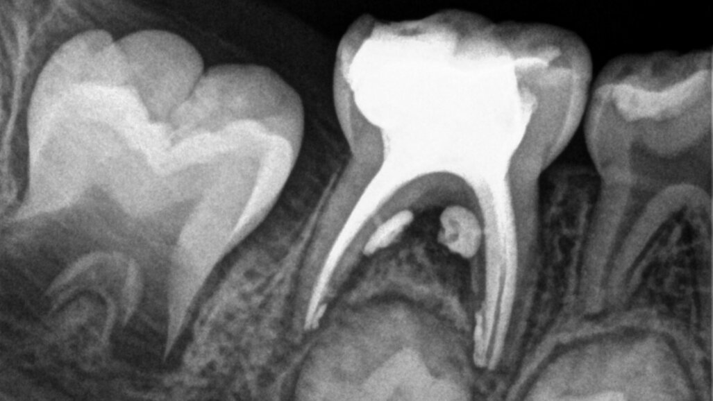 Traitement endocanalaire de molaires temporaires nécrosées — au moyen d’un système de lime unique à mouvement alternatif