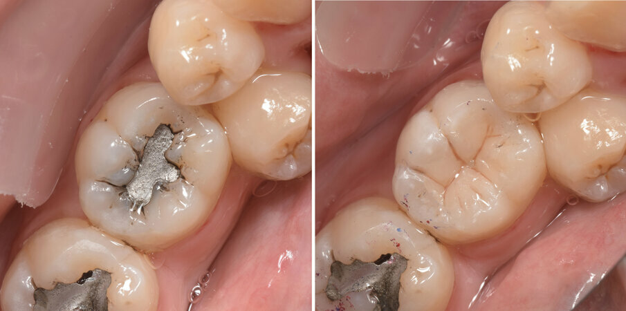 Fig 1a, 1b: Before and after Amalgam replacement with Beautifil range of bioactive nanohybrid composite 