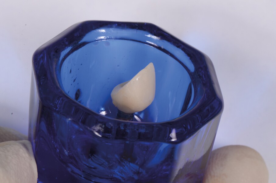 Fig. 15b : La réplique de l’implant est fixée dans un godet Dappen (a),et la dent provisoire personnalisée y est vissée (b). 