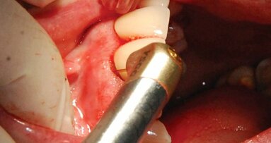 Webinar offers overview of minimally invasive periodontal laser surgery