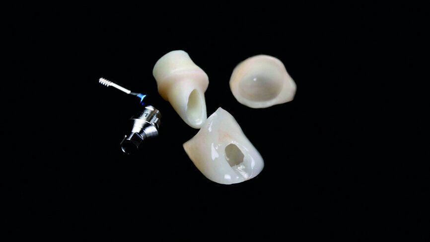 Fig. 21: Final restorations: Zirconium abutment screw with a ceramic facing and a fully anatomical Empress crown. 