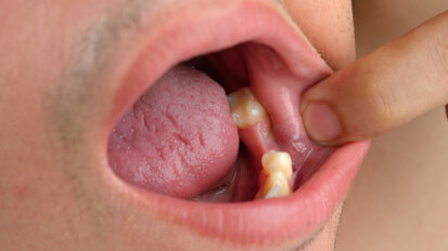 Poor dental health may indicate diabetes risk