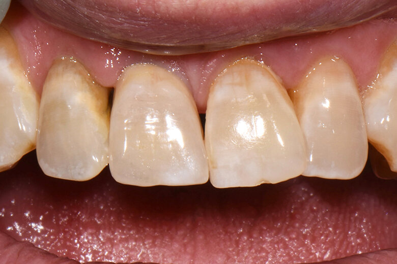 Fig. 7. La corona se integró estéticamente en la dentadura remanente natural.
