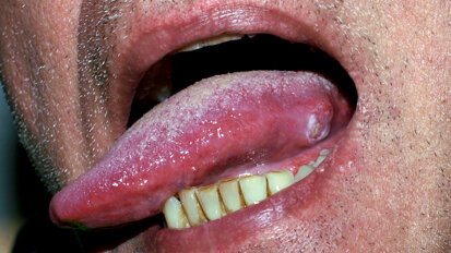 Tongue cancer: Researchers find possible markers for earlier diagnosis