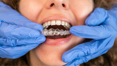 Aligners: More regulation or just a consumer product?