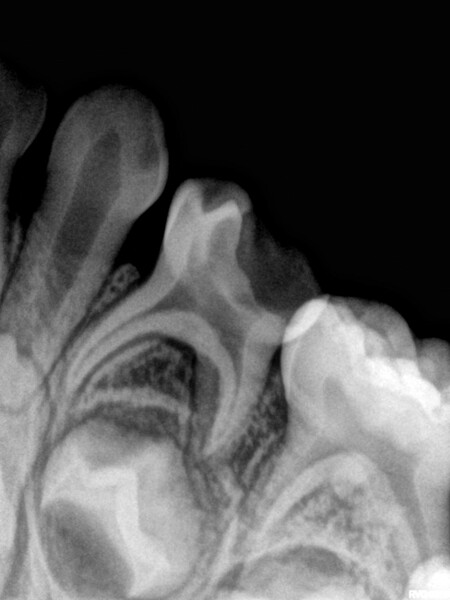 Fig. 15 : Radiographie initiale montrant l’atteinte de la cavité pulpaire