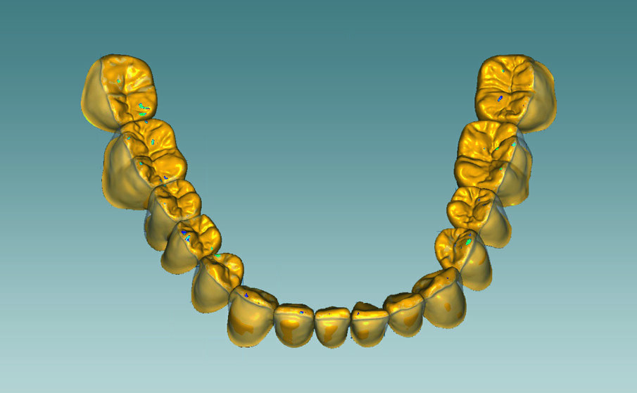 Fig. 3: The occlusal design was created, and the contacts placed on unveneered zirconia. These should not be positioned directly on the veneer interface.