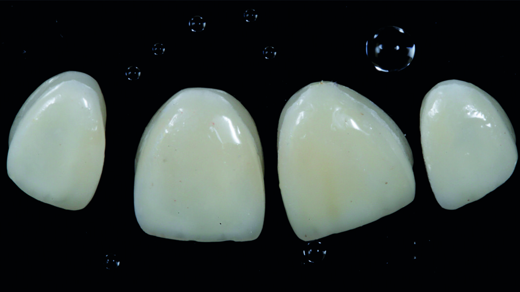 Fig. 10: CAD/CAM veneers after characterisation, nishing and polishing.