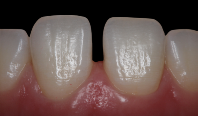 Fig. 2: Preoperative intraoral view of the patient and the midline diastema