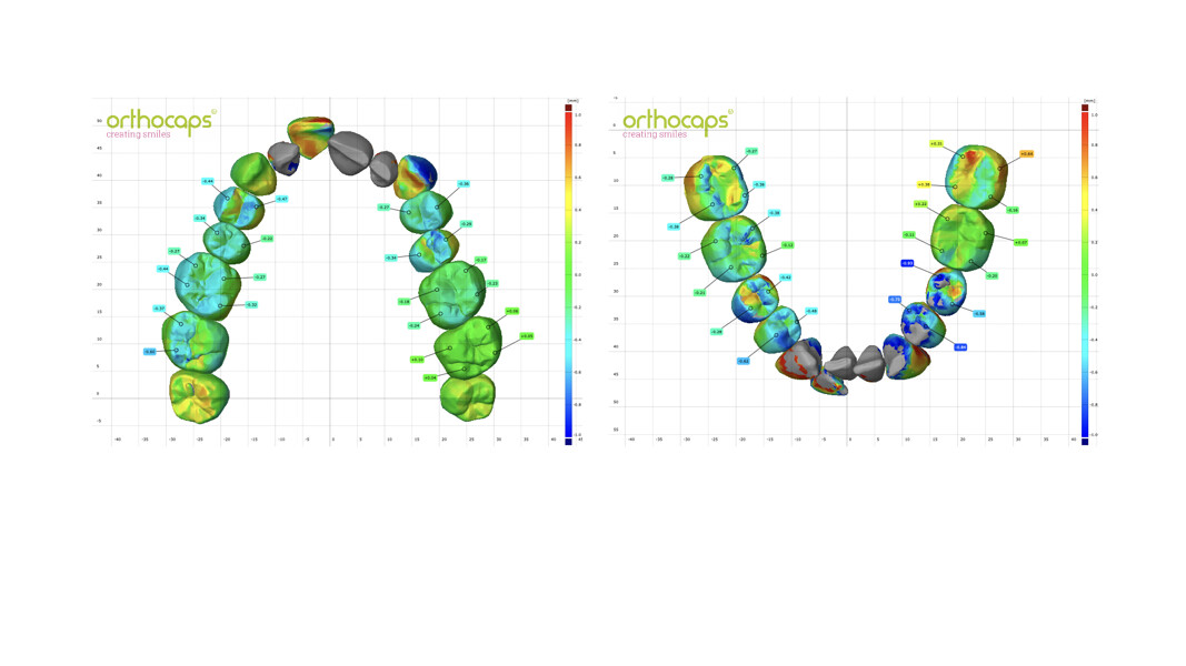 Fig. 61: The deviation analysis showed that there was intrusion of the posterior teeth as expected. The teeth in grey were not included in this analysis, as the amount of movement exceeded the range of 1 mm selected for this superimposition.