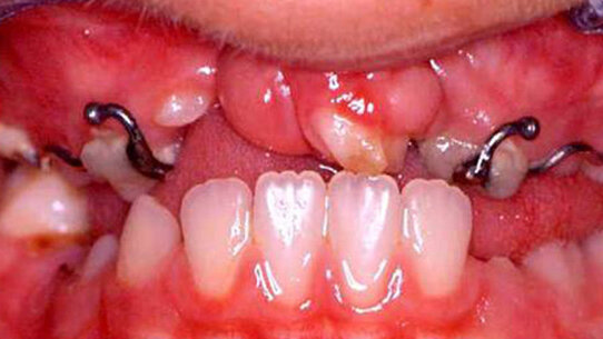 La figura dell’ortodontista nei pazienti con labiopalatoschisi
