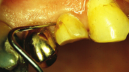 Get back to control – How to deal with bleeding gingiva during restorative procedures