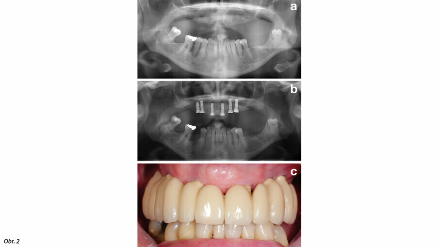 Obr. 2: Před zaváděním implantátu by měla být zajištěna stabilní parodontální situace. Pacient před parodontologickým ošetřením (a), po parodontologickém ošetření a zavedení implantátu (b) a po nasazení protetické náhrady (c).