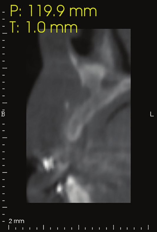 Figure 26:  3 months post-operative CAT view showing the amount of bone loss in the area.