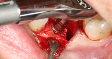 Immediate implant placement and provisionalisation of a mandibular first molar