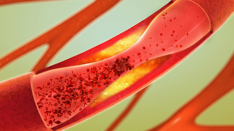 Bakterien im Mund: Auslöser für Arteriosklerose?
