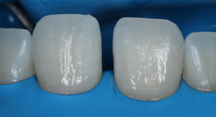 Fig. 4: Teeth preparation