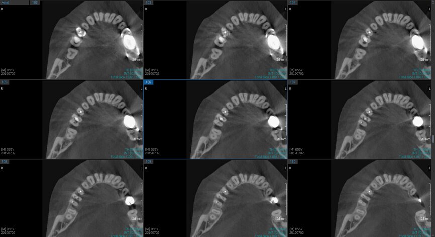Fig.2b: Pre-op CBCT images of tooth #46: No obturation material in the distal and mesiobuccal canal (a); scanty obturation of the canals and breach of the floor of the pulp chamber, no obturation beyond a few millimetres down the orifice (b & c); radiolucency in the furcation area and periapical region of both roots (d -g).