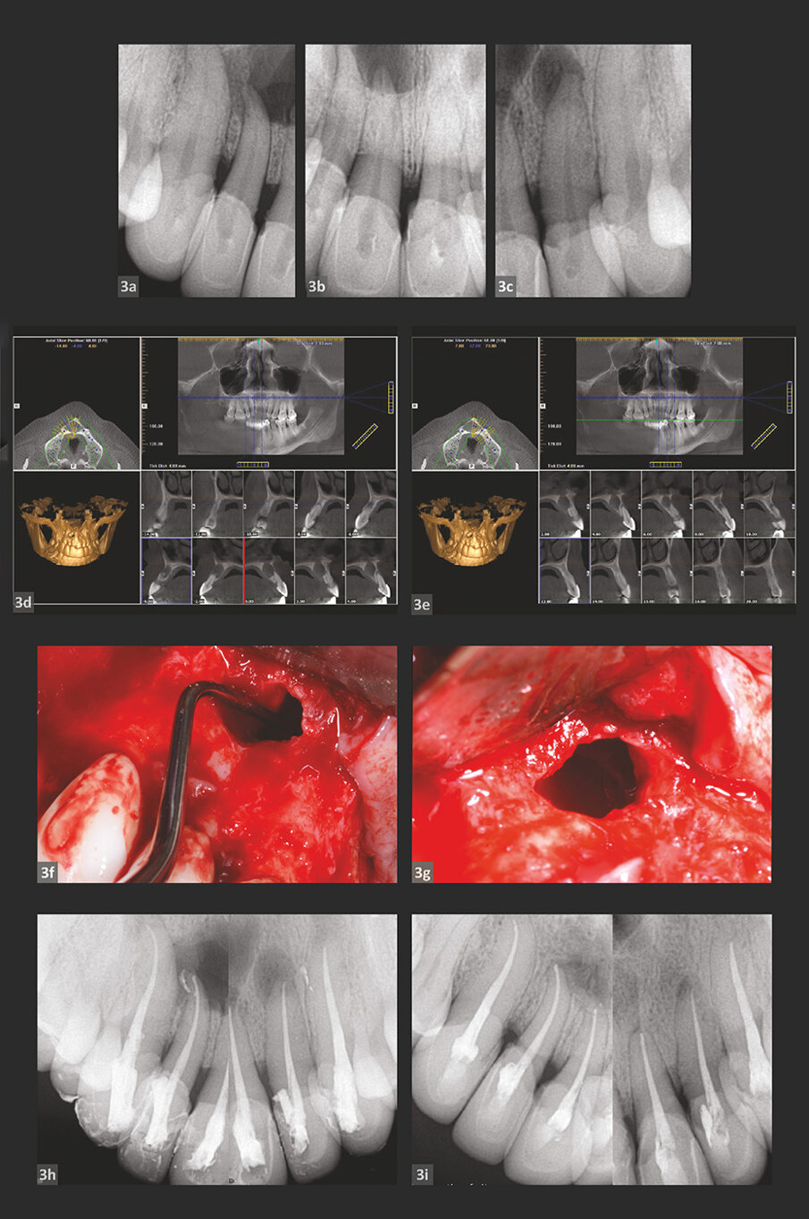 SLUČAJ 3
Slike 3a–3c: Preoperativni rendgenski snimci: gornji prednji zubi.
Slike 3d i 3e: CBCT skeniranje.
Slike 3f i 3g: Intraoperativne fotografije koje pokazuju nedostatke kosti kao rezultat cističnih reakcija.
Slike 3h–3j: Postoperativne radiografije neposredno nakon intervencije.
Slike 3k i 3l: Radiografije nakon18-mesečnog praćenja.
