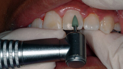 Polishing up your orthodontic finish