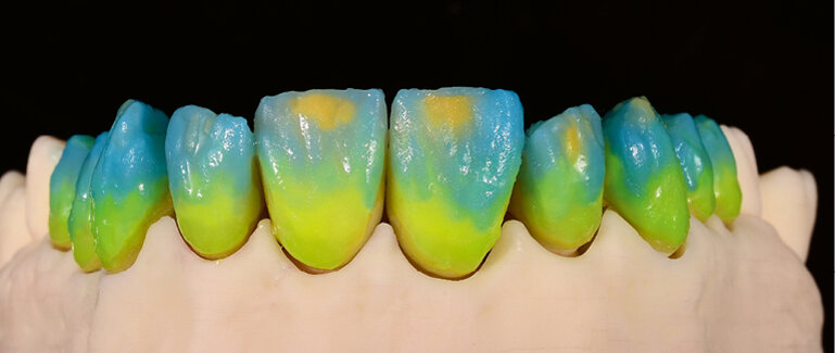 Fig. 12: Application of Transpa Dentin, Transpa Incisal and Transpa Impulse for the corrective firing cycle