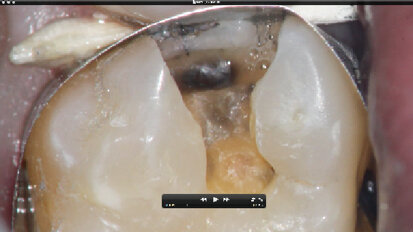 Dentální mikroskop v běžné stomatologii