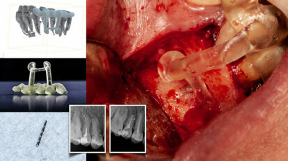 Dynamic navigation—The future of minimally invasive endodontics
