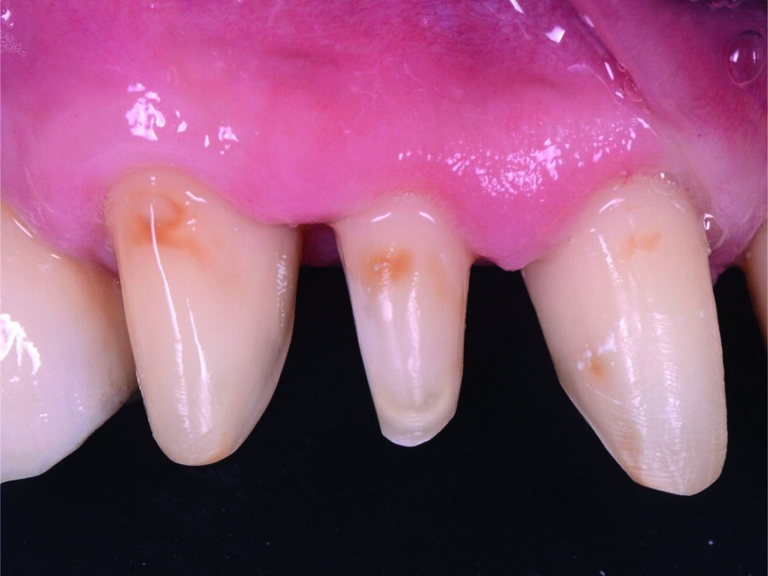 Fig. 5 : Vue détaillée du côté droit des préparations dentaires