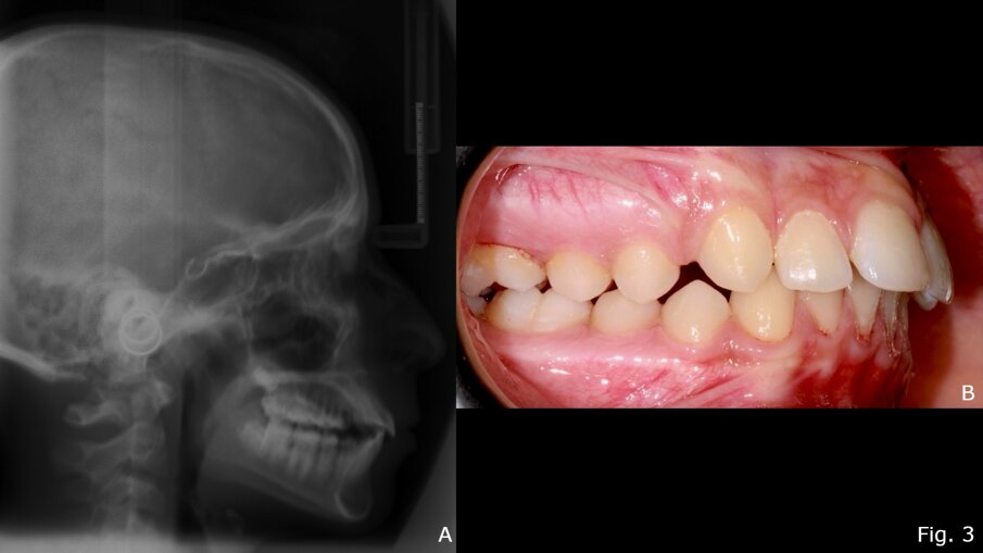 Fig. 3 - Teleradiografia latero-laterale post-trattamento con Twin-Block (A); Foto occlusale destra post-trattamento (B).